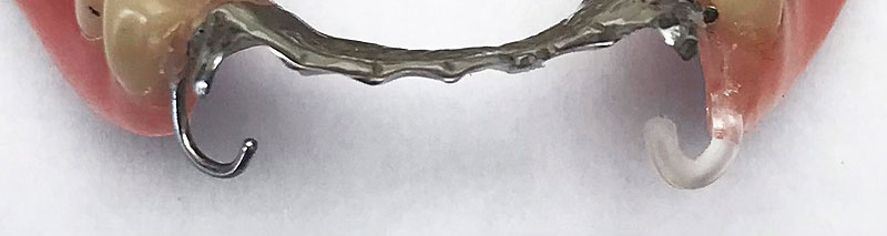 Partial dentures with nylon clip