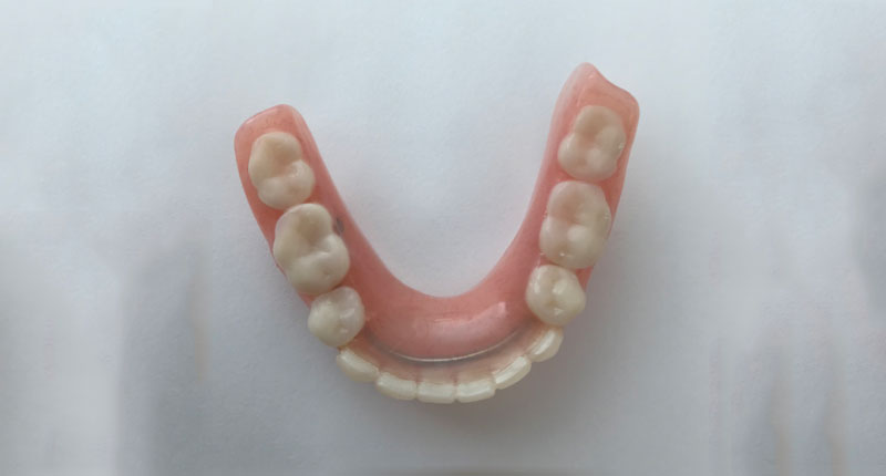 Lower dentures with stainless steel strengthener